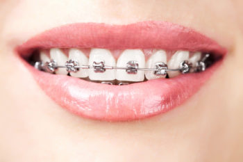 Orthodontie Adulte - Prix, infos, mutuelle, tout savoir - Appareil-dentaire .info